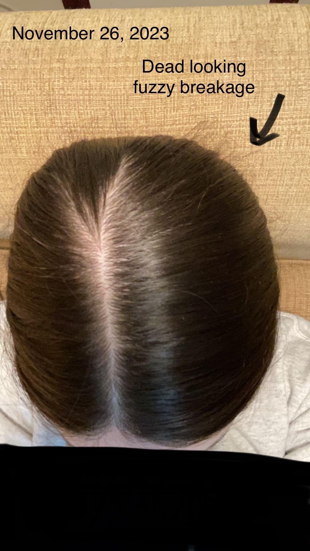 Finally ready to acknowledge what I believe really caused my hair loss. Adderall and Vaping. : r/FemaleHairLoss Finally ready to acknowledge what I believe really caused my hair loss. Adderall and Vaping. : r/FemaleHairLoss